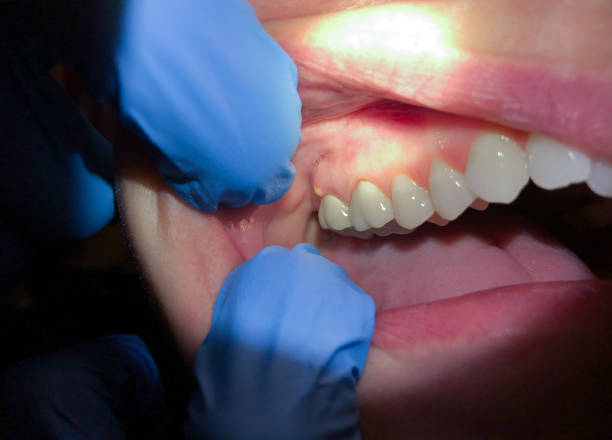 Best Dental Abscess Treatment in Goldsboro, NC
